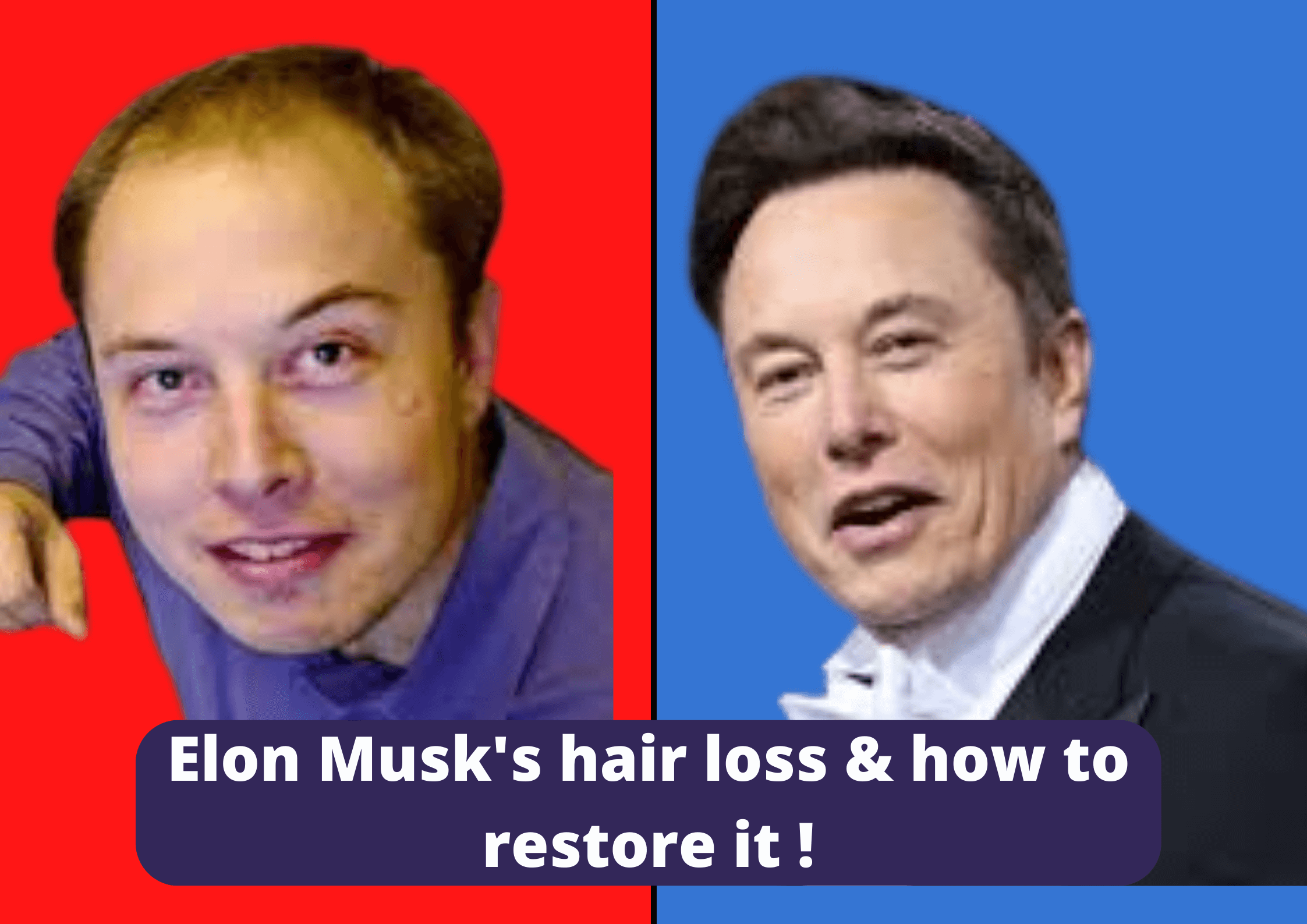You are currently viewing Elon Musk’s hair loss and how to restore it!